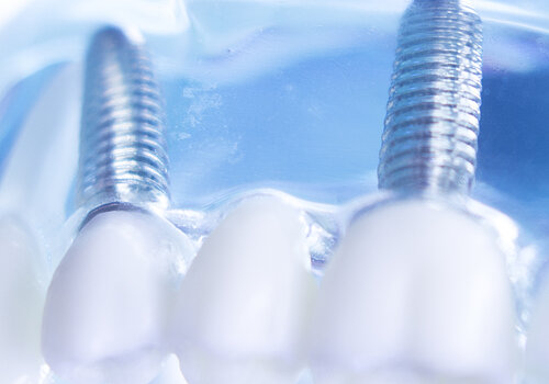 Dentsts dental prosthetic teeth, gums, roots teaching student model with titanium metal screw implant.